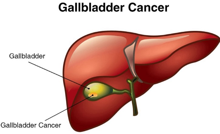 Gall Bladder Cancer Treatment